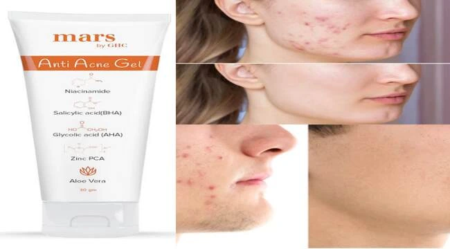 mars anti acne gel use both girls and boys