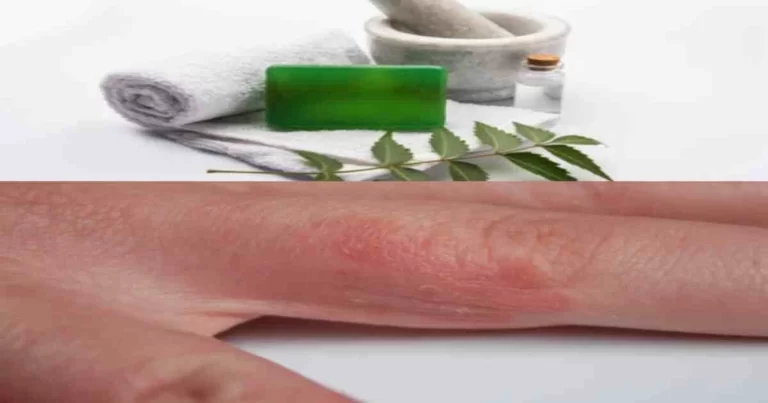 A hand effected itching and a neem soap for treatment
