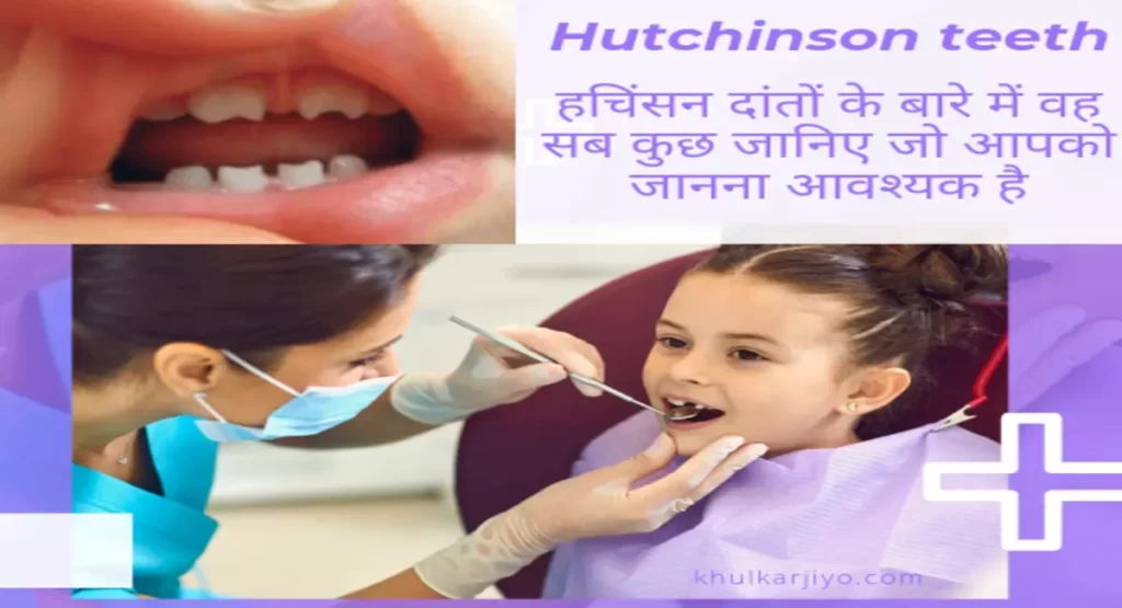 Hutchinson teeth in hindi