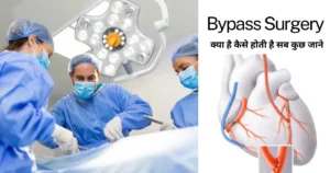 bypass surgery
